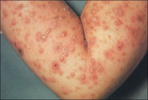 Illustration for article titled Obat Penyakit Herpes Kulit